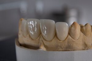 découvrez l'univers des céramiques dentaires, une solution esthétique et durable pour restaurer votre sourire. apprenez comment ces matériaux innovants allient fonctionnalité et beauté, offrant des résultats naturels et durables pour toutes vos besoins dentaires.